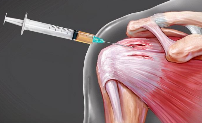 Plasma Rico em Plaquetas (PRP) para Lesão do Manguito Rotador: Como o PRP Pode Ajudar na Recuperação do Ombro?