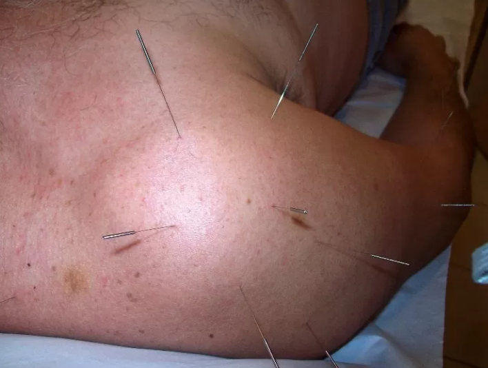 Acupuntura no Tratamento de Dores Musculares: Alívio Natural e Eficaz